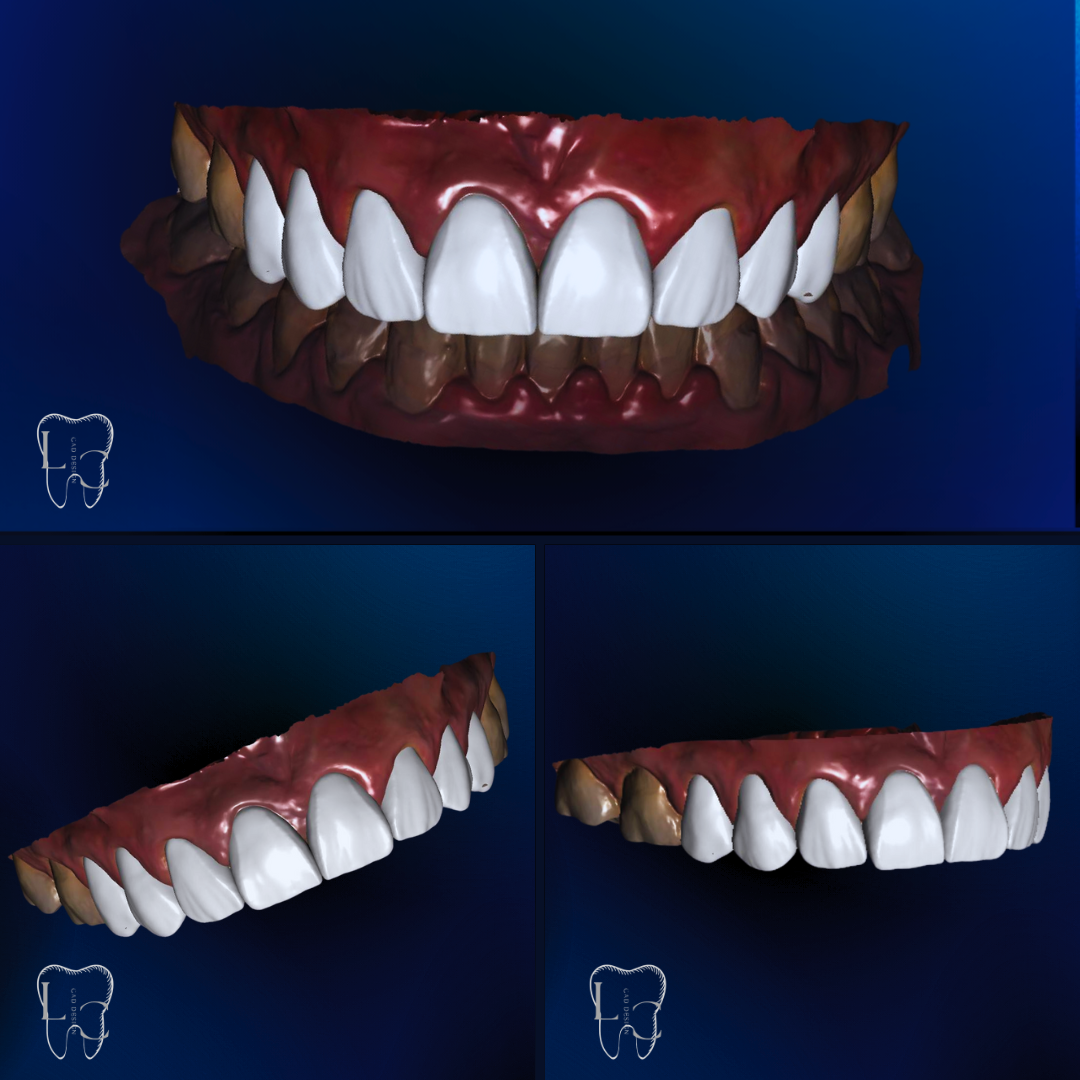 Enceramento digital no Exocad