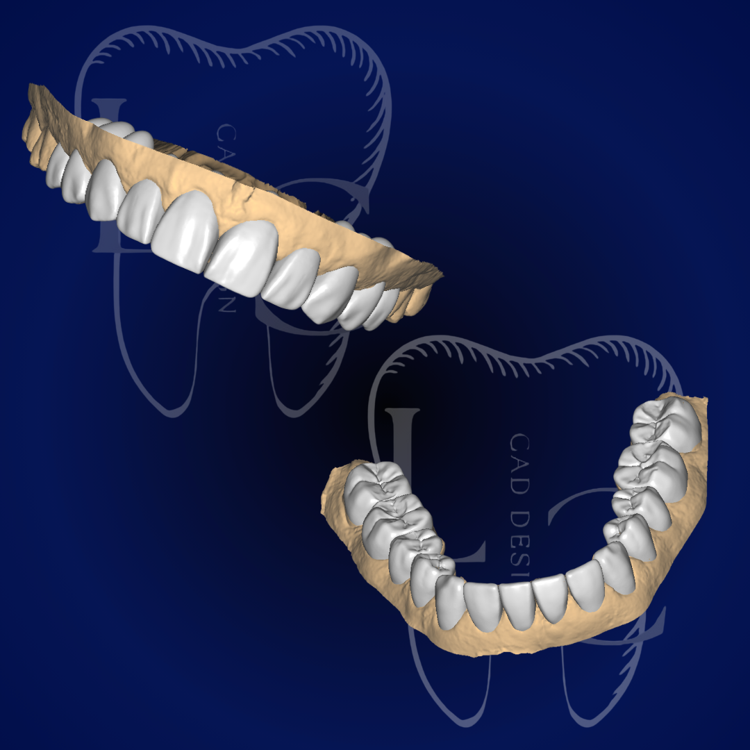 Enceramento arcada superior no Exocad
