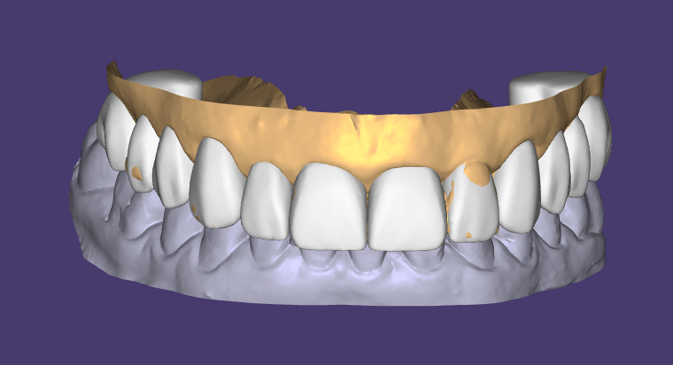 Enceramento estético no Exocad