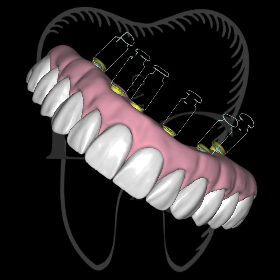 Protocolo total arcada completa no Exocad